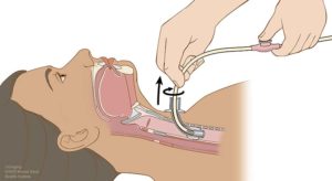 How to suction a trach tube