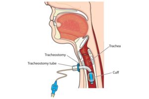 Tracheostomy, anatomy of a trach and stoma